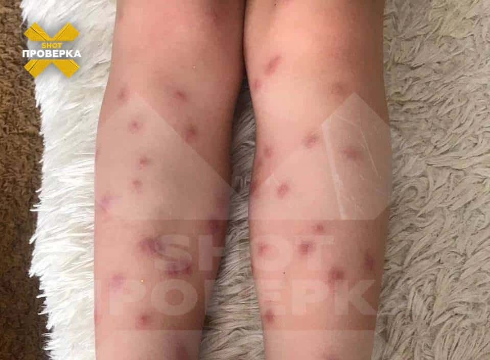 Россияне стали жаловаться на личинок червей, которые проникают под кожу во время купания