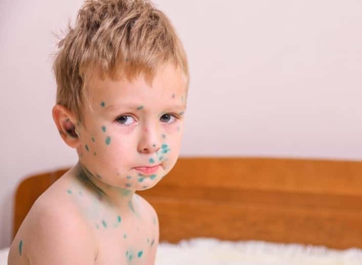 В Первоуральске выявили 91 случай ветрянки среди детей