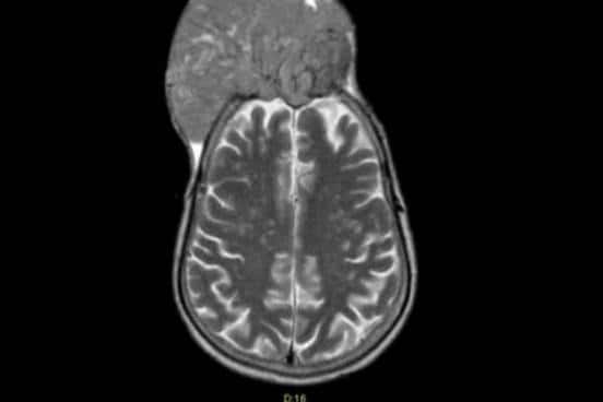 В Свердловской области медики спасли мужчину, у которого опухоль буквально «съела» череп