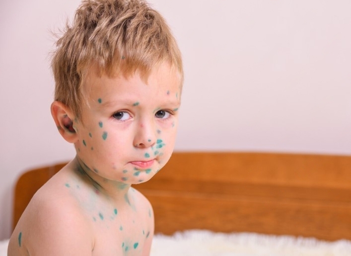 В Первоуральске выявили 91 случай ветрянки среди детей | В детской больнице Первоуральска обнаружили 91 случай заражения ветряной оспой В Первоуральске выявили 91 случай ветрянки среди детей | В детской больнице Первоуральска обнаружили 91 случай заражения ветряной оспой